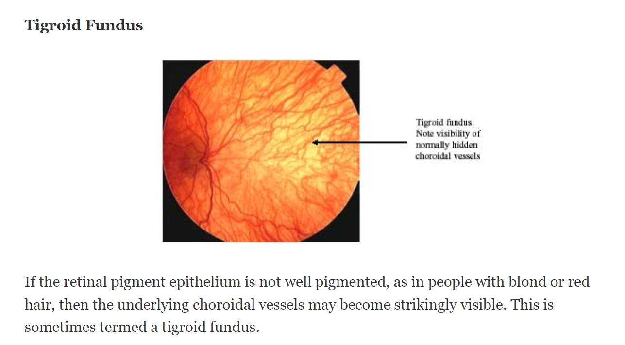 범무늬 안저 증상